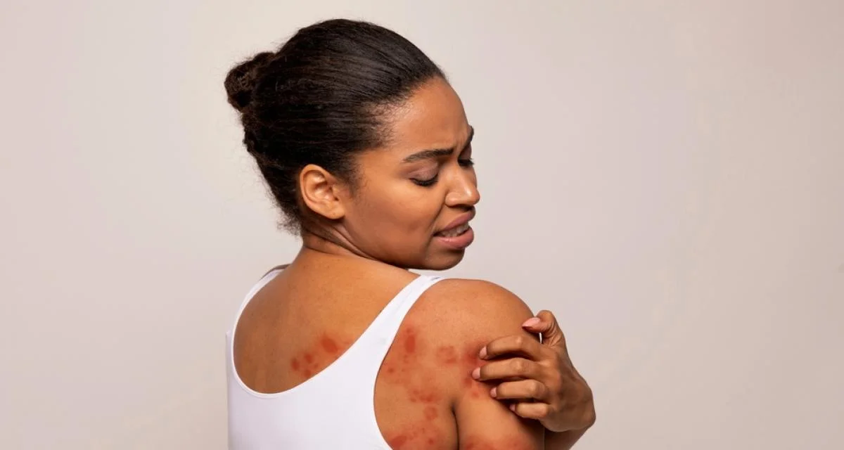 Understanding Shingles: Symptoms, Complications, and Prevention